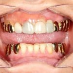 gold teeth