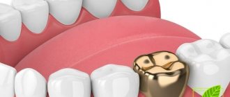 Gold teeth pros and cons